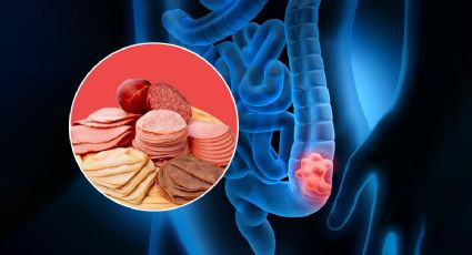 Conoce los 3 alimentos que pueden generar cáncer de colon y no lo sabías