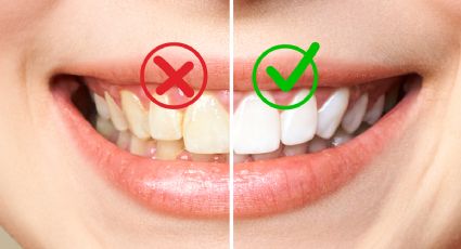 Con estos 4 ingredientes puedes eliminar el sarro de tus dientes