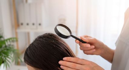 ¿Cómo eliminar la caspa del cabello? 3 remedios caseros para un pelo sano y hermoso