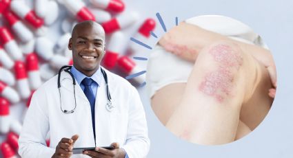 ¿Cómo evitar la psoriasis? Según los doctores