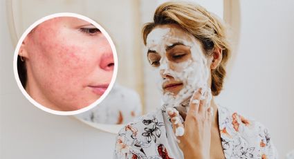 ¿Tienes rosácea? Prepara esta mascarilla con 3 ingredientes de tu cocina para calmar la piel