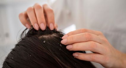 Elimina la caspa del pelo de forma natural con esta mezcla potente