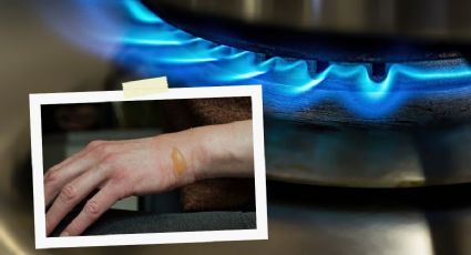 Accidentes de cocina: Aprende cómo prevenir y tratar quemaduras a la hora de cocinar